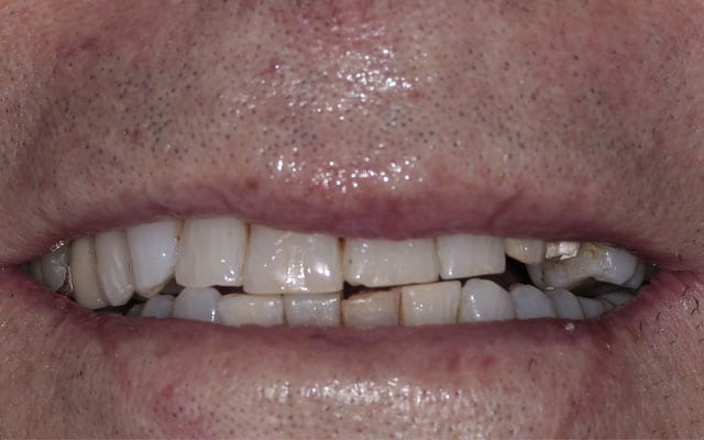 牙齿贴面与牙齿贴膜 | 洛杉矶美容牙医 | Mobasser博士