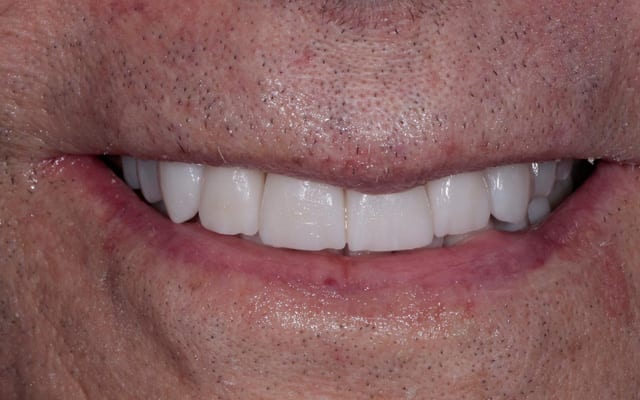 Dental Reconstruction After