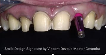 during Dental-Implants