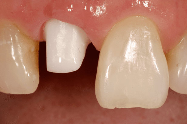 Pros and Cons of Dental Implant