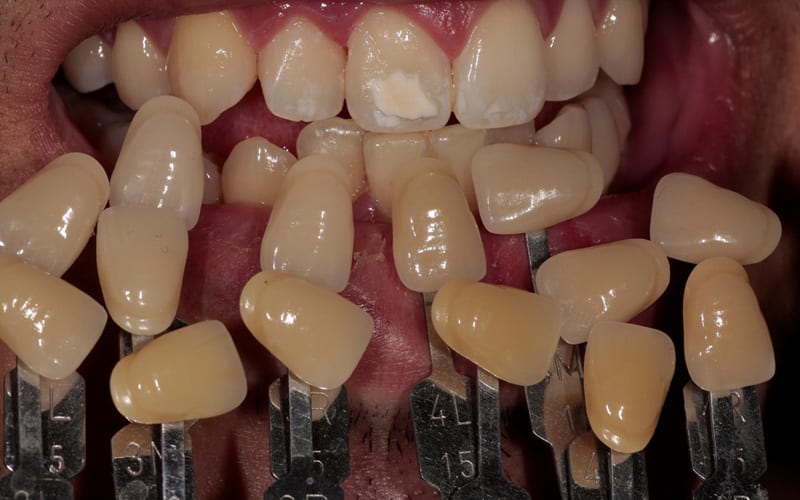 porcelain-veneers-los-angeles.jpg