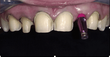 during Dental-Implants