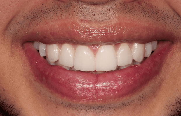 porcelain-veneers-los-angeles.jpg
