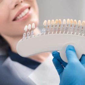 How Much Do Porcelain Veneers Cost In Los Angeles