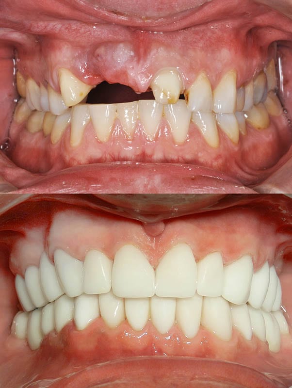 a Full Mouth Reconstruction in Los Angeles