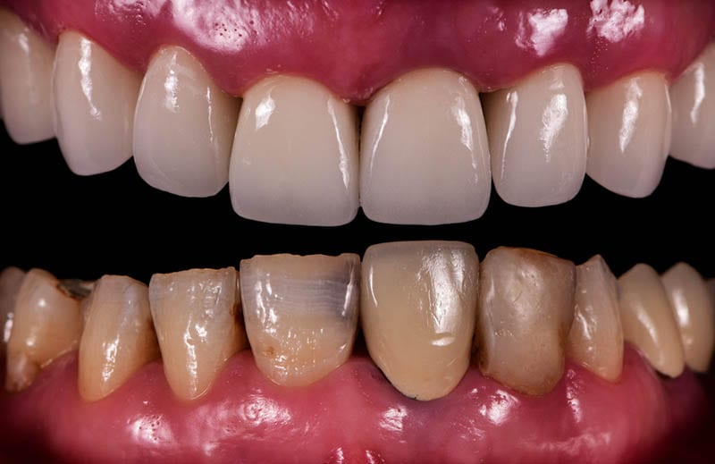 how much do porcelain veneers cost in Los Angeles