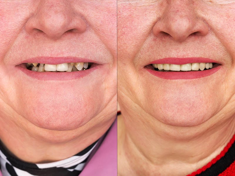 A Full Mouth Reconstruction in Los Angeles