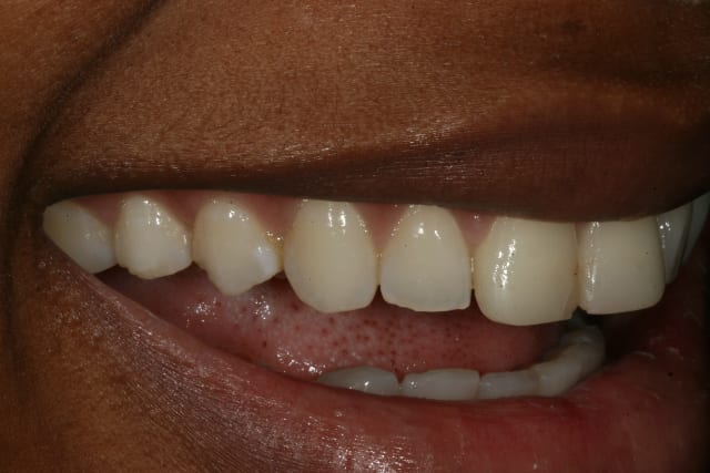 lumineers porcelain veneers before