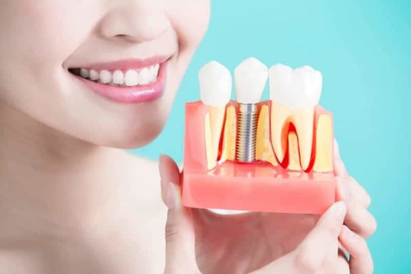 Avez-vous besoin d'implants dentaires ? Los Angeles Implant Dentist