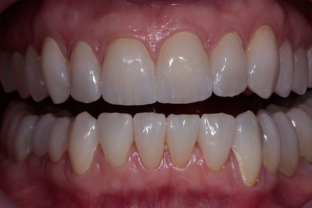 Zirconia Veneers in Los Angeles | Dental Veneers | Dr. Anthony Mobasser