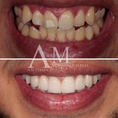 牙齿贴面与牙齿贴膜 | 洛杉矶美容牙医 | Mobasser博士