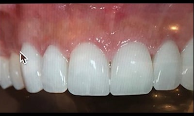 after discolored teeth with red swollen gums