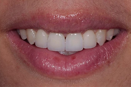 Porcelain Crown Front Tooth after
