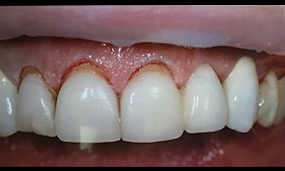 歯が変色し、歯茎が赤く腫れる前に