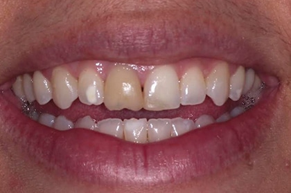 Porcelain Crown Front Tooth before