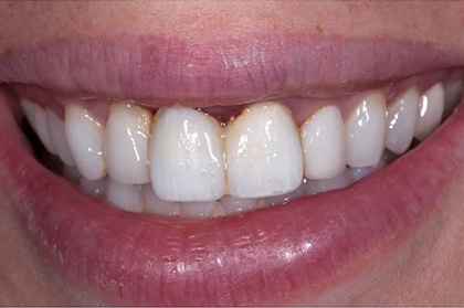 Porcelain Crown Front Tooth Los Angeles Befpre