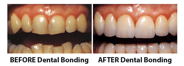 dental bonding in Beverly Hills