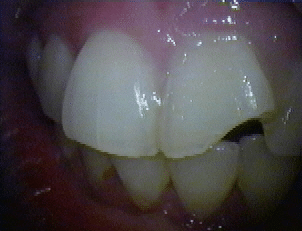 Adhesión dental