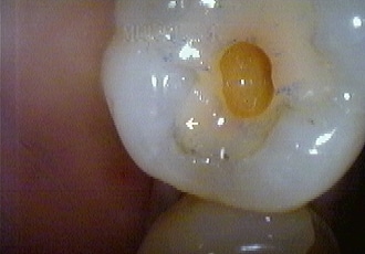 adhesión dental
