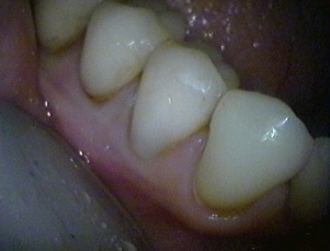adhesión dental