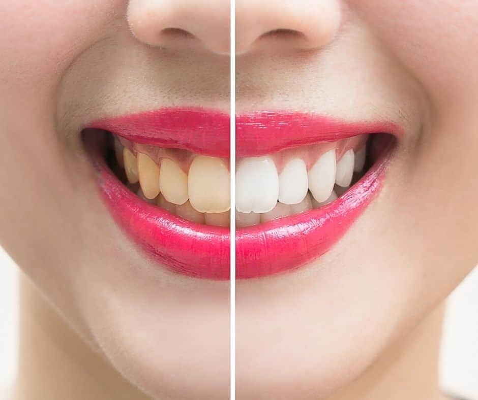 Teeth Whitening in Los Angeles Cosmetic Dentist Dr. Mobasser