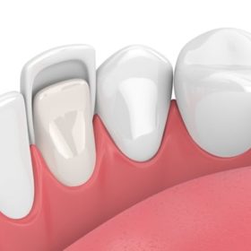 how much do porcelain veneers cost
