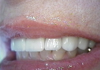 dental veneers after 