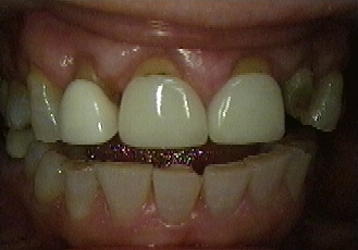 dental veneers before 