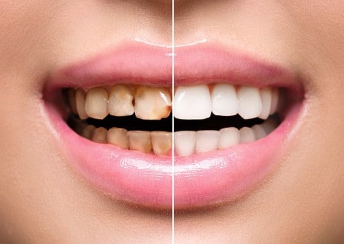 Cosmetic Dentistry Los Angeles Dr Anthony Mobasser