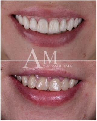 Cosmetic Dentistry in Los Angeles - Cosmetic Dentist - Dr. Anthony Mobasser