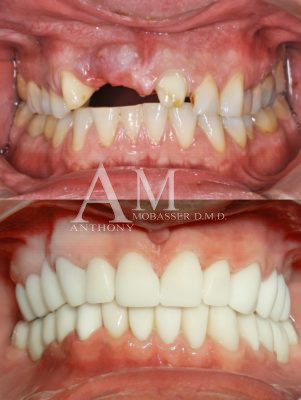 Dentista ricostruttivo a Beverly Hills Dr. Anthony Mobasser