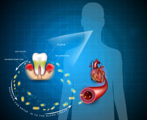 发现牙龈疾病与心脏病之间存在联系