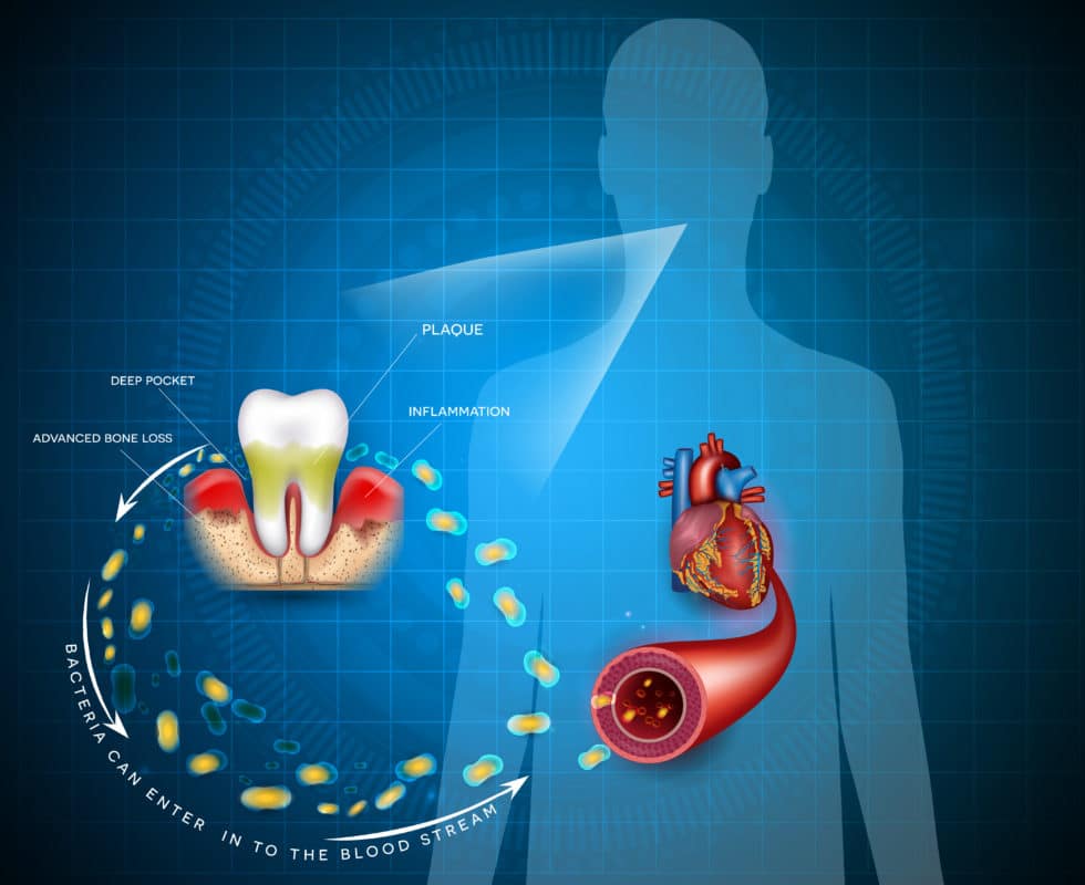 Link Found Between Gum Disease and Heart Disease