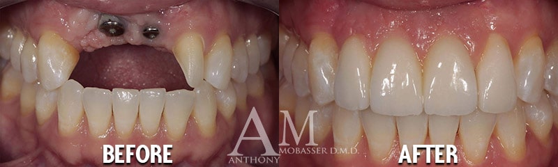 before after dental implants in los angeles dr anthony mobasser