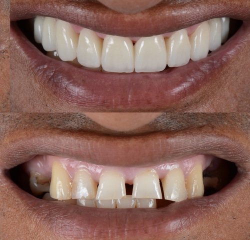 Cosmetic-Dentist-in-Los-Angeles---Dr.-Anthony-Mobasser---Full-Mouth-Reconstruction---Smile-Makeover