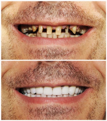 Cosmetic Dentistry in Los Angeles - Cosmetic Dentist - Dr. Anthony Mobasser