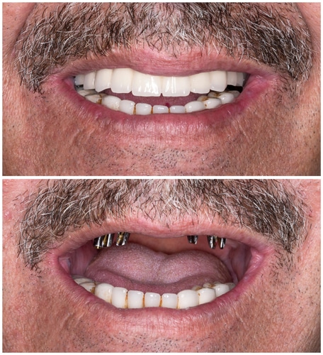 Full-Mouth-Reconstruction-in-Beverly-Hills-and-Los-Angeles