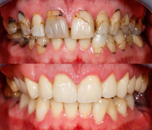 Reconstruction de couronnes en porcelaine-Dr. Anthony-Mobasser-Dentiste cosmétique-Los-Angeles