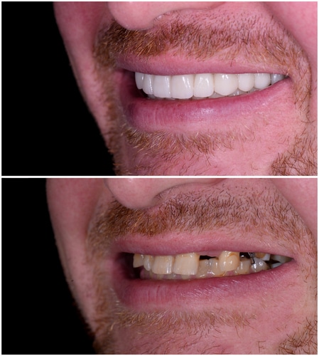贝弗利山的牙科整形医师-Anthony-Mobasser 牙科整形医师