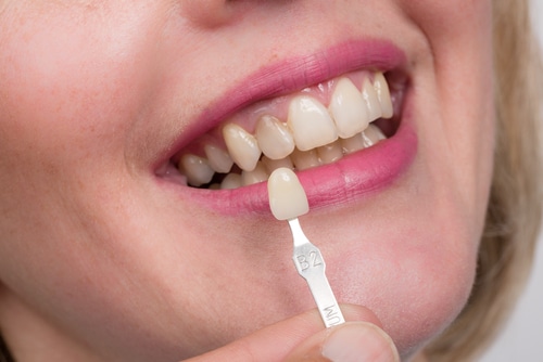 Faccette dentali Lumineer Dentista di Los Angeles Consultazioni gratuite