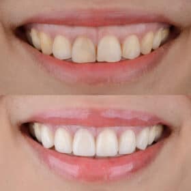 Veneers Before and After Process Free Consultations LA Dentist