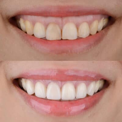 Veneers Before and After Process Free Consultations LA Dentist