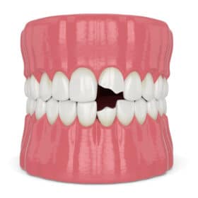 4 Benefits of Dental Reconstruction Hollywood Dentist Free Consultation