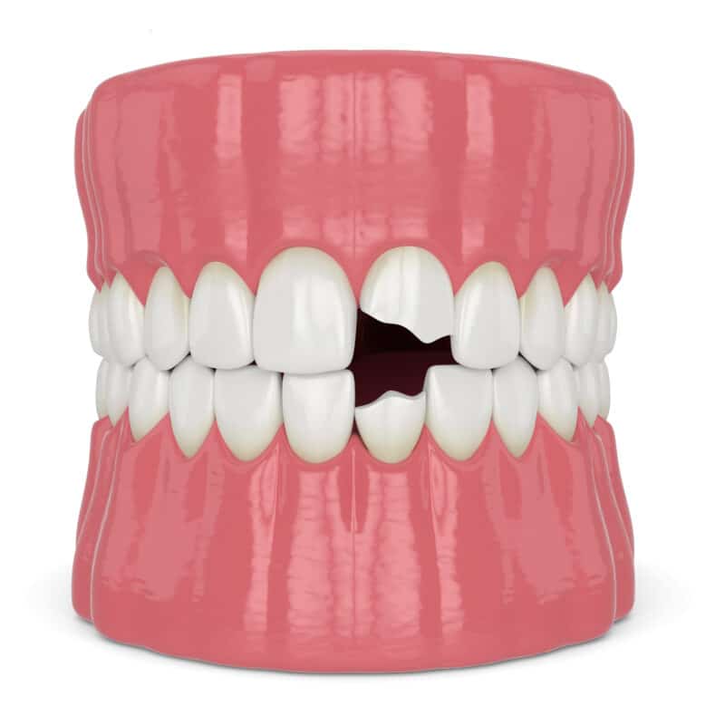 4 Benefits of Dental Reconstruction Hollywood Dentist Free Consultation
