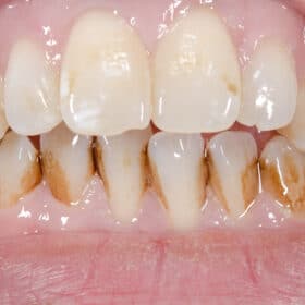 Solutions for Discolored Teeth Los Angeles Dentist Free Consultations