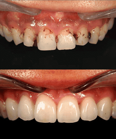 Antes y después de carillas de porcelana en Los Ángeles - Dentista cosmético en Los Ángeles - Dr.-Anthony-Mobasser