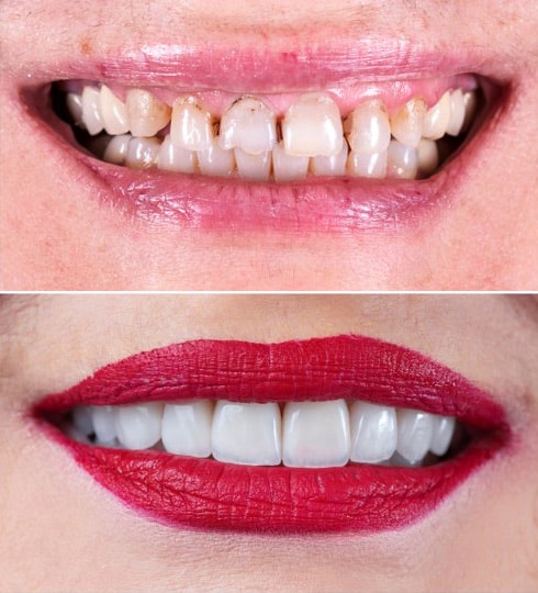 Reconstruction buccale complète--avant-et-après---Los-Angeles-Cosmetic-Dentist---Dr.-Anthony-Mobasser