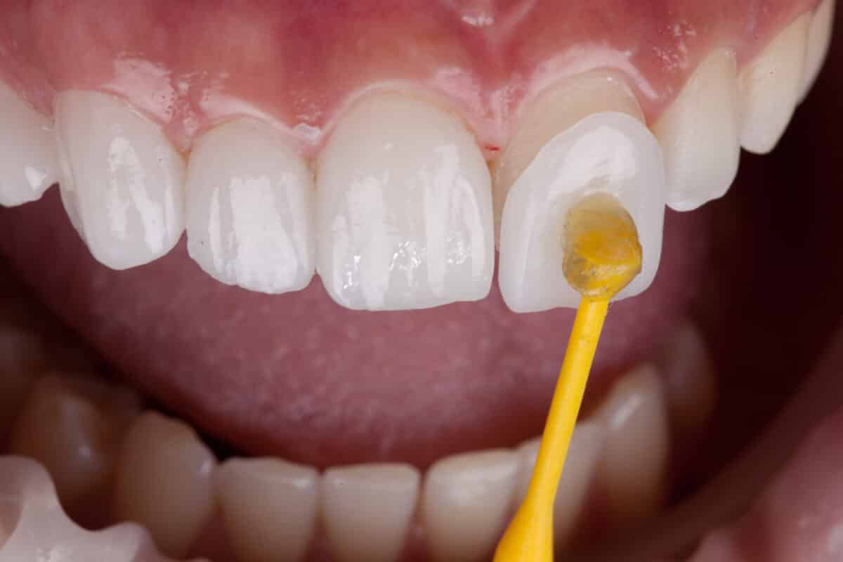 Los Angeles Veneer Dentist Smile Makeover Free Consultations