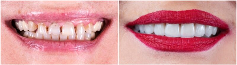 Analysis of a Cosmetic Dental Treatment | Los Angeles Cosmetic Dentist
