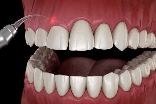 Avantages du traitement de contournement des gencives Dentiste de Los Angeles Consultations gratuites
